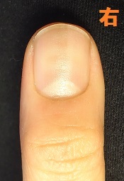 爪のデコボコの原因になる爪噛みも治せる深爪矯正の変化画像