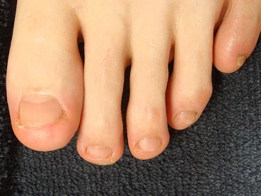 爪をむしる癖を解決した足の深爪矯正終了後の変化画像