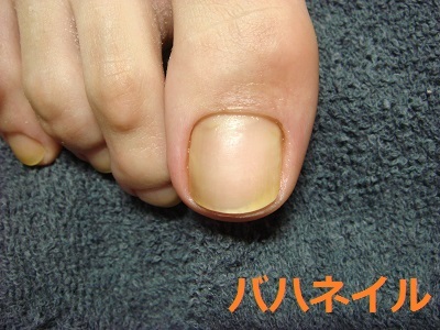 足の親指の深爪矯正カイナメソッドの変化画像