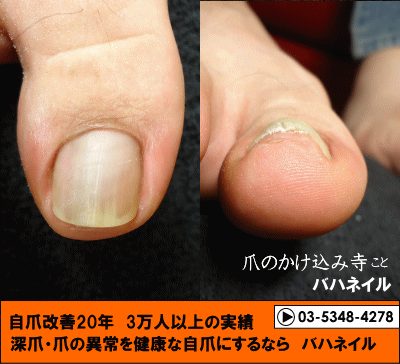 足の巻爪矯正の変化画像