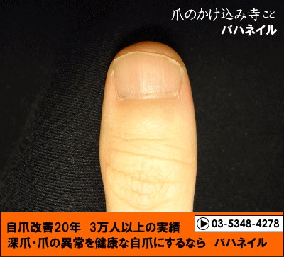 男性のゲスト　親指の深爪自立矯正の変化画像