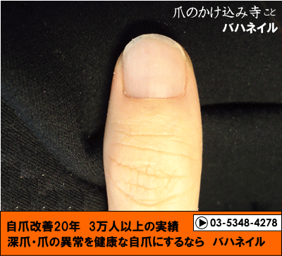 男性のゲスト　親指の深爪自立矯正の変化画像