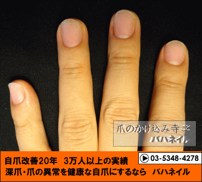 爪噛み癖も治るカイナメソッドによる深爪矯正の爪の変化画像