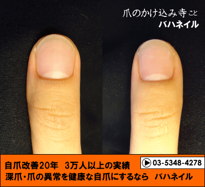 爪噛み癖も治るカイナメソッドによる深爪矯正の爪の変化画像