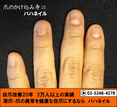 深爪とデコボコ爪が治る　カイナメソッドによる深爪自立矯正の変化画像