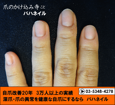 深爪とデコボコ爪が治る　カイナメソッドによる深爪自立矯正の変化画像