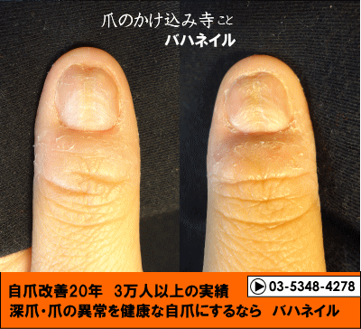 深爪やデコボコ爪も治るカイナメソッドの自爪矯正変化画像