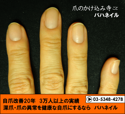 カイナメソッドの深爪自立矯正で爪噛み癖も治った方の変化画像