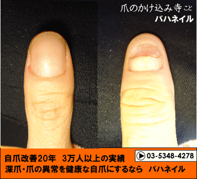 カイナメソッドの深爪自立矯正で爪噛み癖も治った方の変化画像