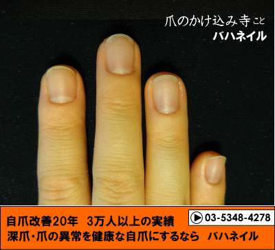 カイナメソッドの深爪自立矯正の爪の変化画像