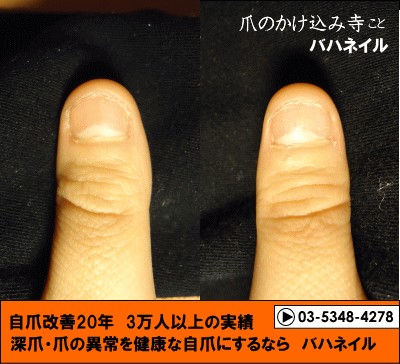 カイナメソッドの深爪自立矯正の爪の変化画像
