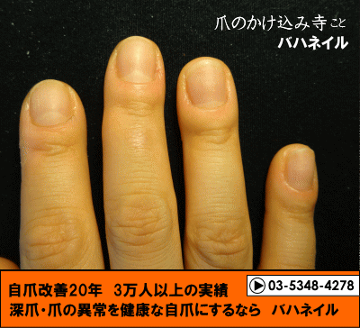 爪をむしる癖も治すカイナメソッドの深爪自立矯正の変化画像