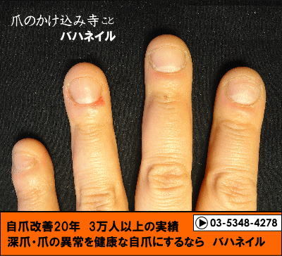 爪をむしる癖も治すカイナメソッドの深爪自立矯正の変化画像
