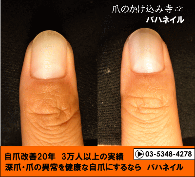 男性の爪のデコボコが治る自爪矯正の変化画像