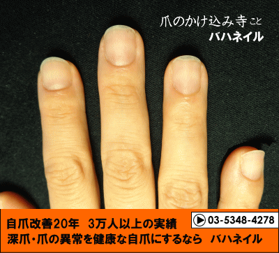 爪噛み癖も治るのはカイナメソッドの深爪矯正だから
