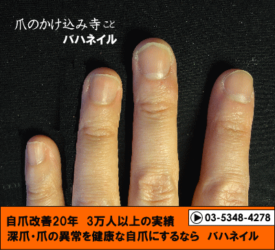爪噛みも治るカイナメソッドによる深爪矯正の変化画像