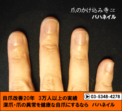 爪噛みも治るカイナメソッドによる深爪矯正の変化画像