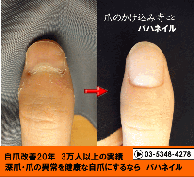 深爪以外のデコボコ爪や爪をむしる癖による爪トラブルの矯正結果