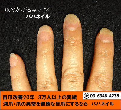 爪が離れる症状の自爪矯正の変化画像
