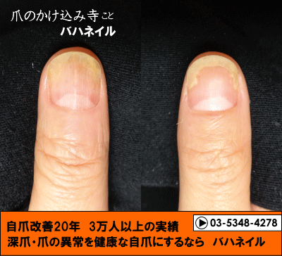 爪が離れる症状の自爪矯正の変化画像