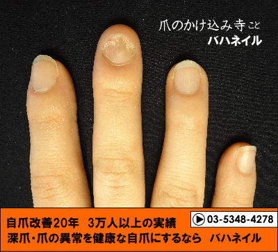 爪をむしる癖からデコボコ爪も治るカイナメソッドの深爪矯正の変化画像