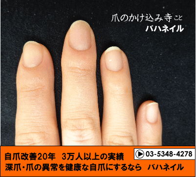 爪をむしる癖からデコボコ爪も治るカイナメソッドの深爪矯正の変化画像