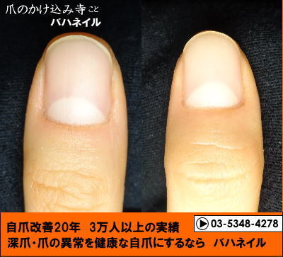 爪のデコボコの自爪矯正の変化画像