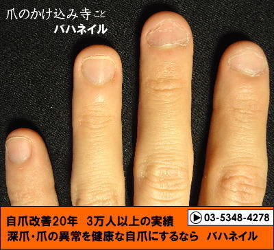 爪噛みの男性の深爪矯正の変化画像