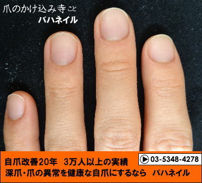 爪噛みの男性の深爪矯正の変化画像