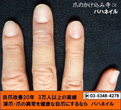 爪噛みの深爪矯正の変化画像