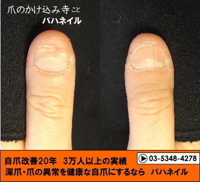 爪噛みの深爪矯正の変化画像