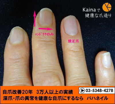 kainaで自爪改善