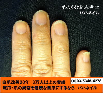 カイナメソッドで深爪を治した爪の変化画像