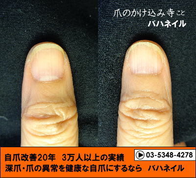 深爪矯正で深爪を治した爪の変化画像