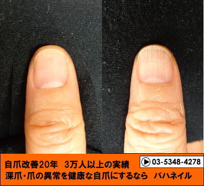 カイナメソッドで深爪矯正をした爪の変化画像