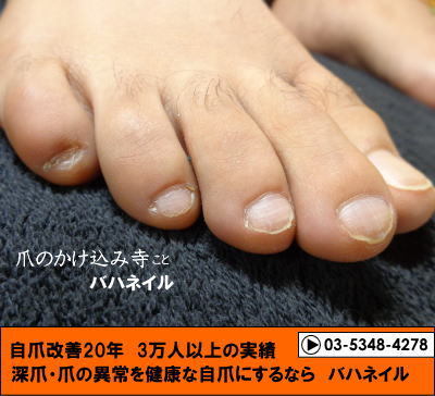 男性のゲスト　足の深爪自立矯正の変化画像