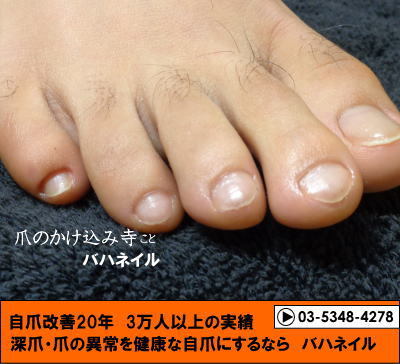 男性のゲスト　足の深爪自立矯正の変化画像