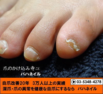 足の小指の爪がキレイに生えない(ノД`)　カイナメソッドによる深爪自立矯正　