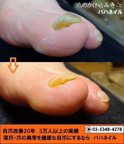 足の親指の爪が分厚いのは爪甲鉤湾症