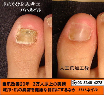 足の親指の爪が分厚いのは爪甲鉤湾症