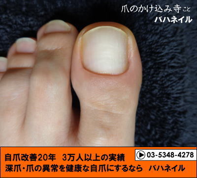 足の親指の爪のデコボコの変化画像