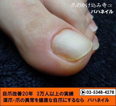 足の親指の爪のデコボコの変化画像