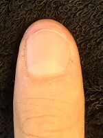 深爪自立矯正で指もスリム！爪の変化画像