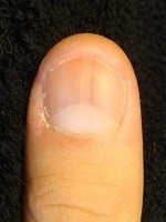 深爪自立矯正で指もスリムに変わった爪の画像