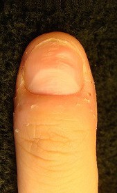 爪のデコボコ改善と爪の病気