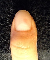 爪のデコボコ　爪の病気の変化画像