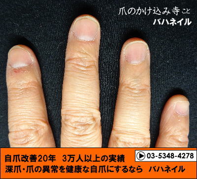 カイナメソッドによる深爪自立矯正で爪の形も整う　爪の変化画像