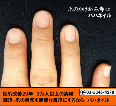深爪自立矯正(カイナメソッド)　爪の変形　変化画像