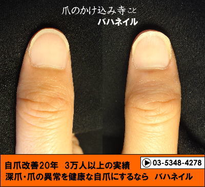 深爪自立矯正(カイナメソッド)　爪の変形　変化画像