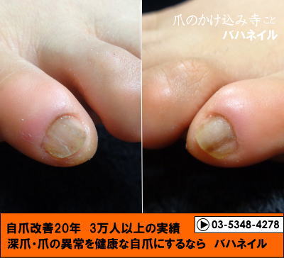 足の小指の爪が小さい人の足の深爪矯正